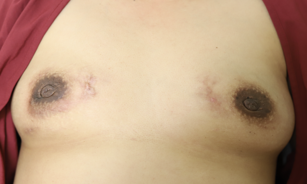 Granulomatous mastitis